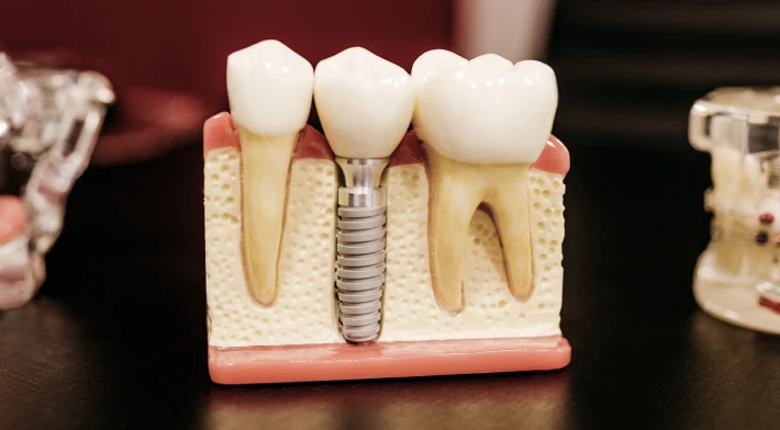 Implant dentaire au clinic Loire Velay