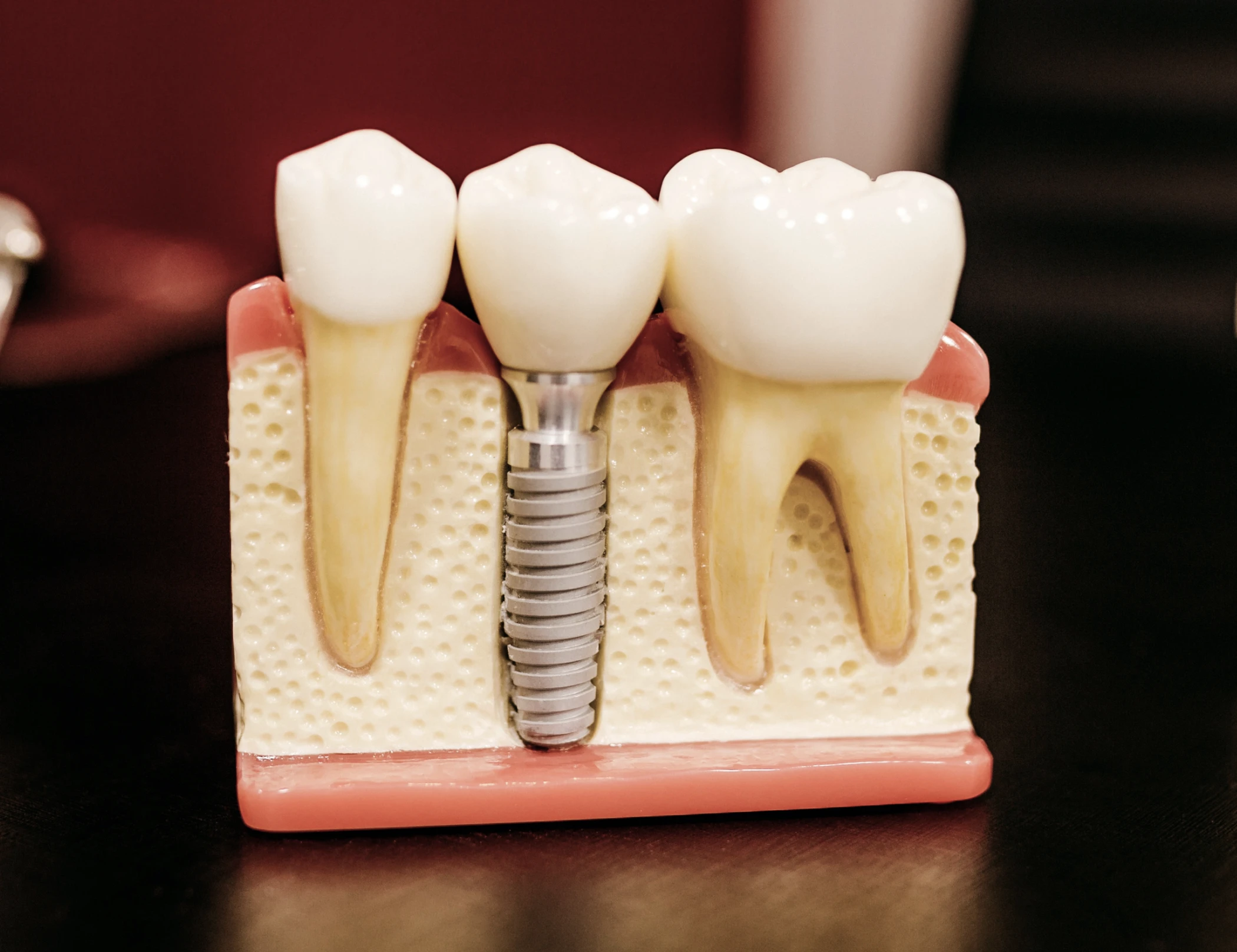 Implants dentaires proche Monistrol-sur-Loire
